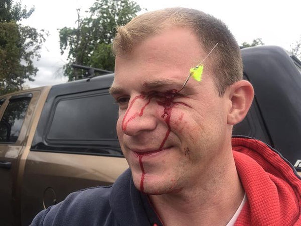 Fishhook Injuries - Keeping Your Eyes Safe!